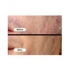 Before and after comparison of skin treatment on a person's face.