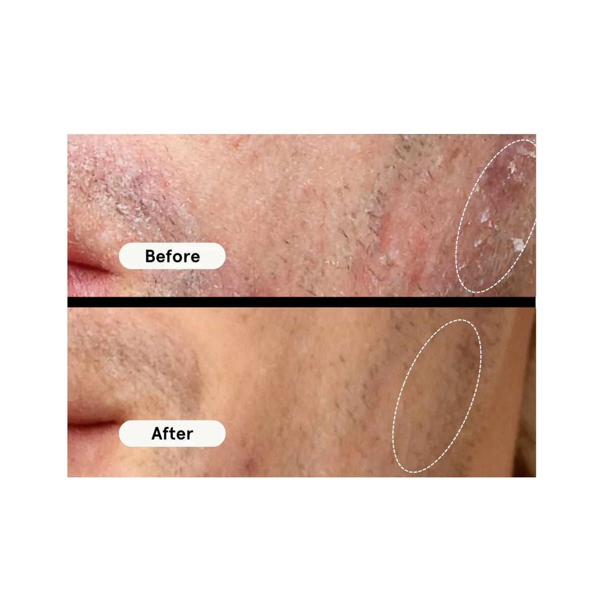 Before and after comparison of skin treatment on a person's face.